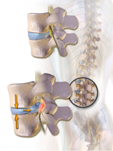 Herniated_Disc