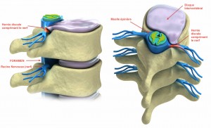 Prolapse of intervertebral disc isolated on white